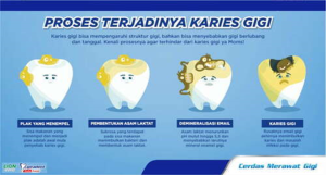 Penyebab Utama Karies